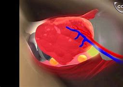 Image result for Endoscopic Thyroidectomy