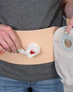 Image result for Ostomy Pouching System