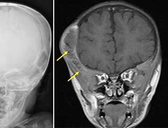 Image result for Langerhans Cell Histiocytosis Cancer