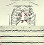 Image result for 12 Lead EKG Strip Phillips