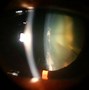 Image result for Diabetic Posterior Capsular Cataract