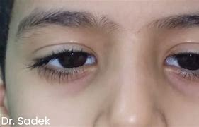 Image result for Pendular Nystagmus