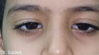 Image result for Unilateral Nystagmus