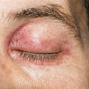 Image result for Itchy Eyes Allergies