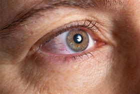 Image result for Pink Eye or Allergies