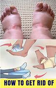 Image result for Swollen Ankles Red Rash