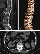 Image result for Lumbosacral Subluxation