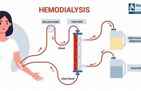 Image result for How Effective Is Dialysis