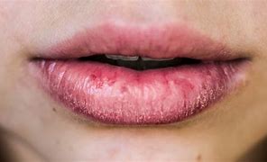 Image result for Irritated Lip Piercing