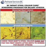 Image result for Acholic Stool Chart