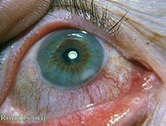 Image result for Blepharitis Pics