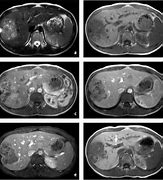 Image result for Liver Cancer MRI