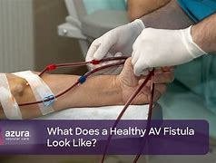 Image result for AV Fistula Dialysis