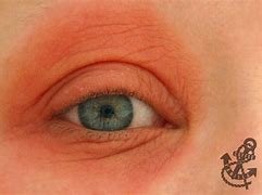 Image result for Itchy Eyes Allergies