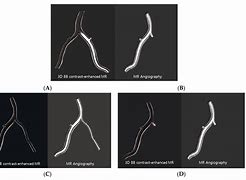 Image result for Vertebral Artery Dissection Symptoms