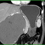 Image result for Hemangioma Liver MRI