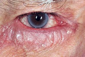 Image result for Allergic Rash around Eyes