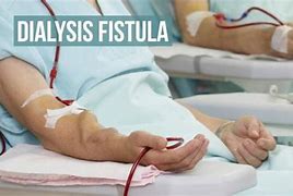 Image result for How Effective Is Dialysis