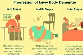 Image result for Vascular Dementia Life Expectancy Chart