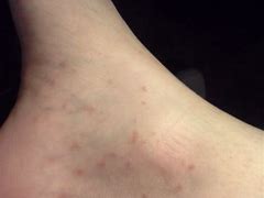 Image result for Rash On Foot and Ankle