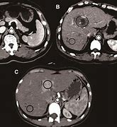 Image result for Hemangioma Liver MRI