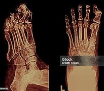 Image result for Normal X-ray Kaki Manusia