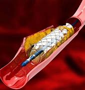 Image result for Vascular Surgery Procedure