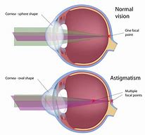 Image result for Lasik Eye Surgery for Astigmatism