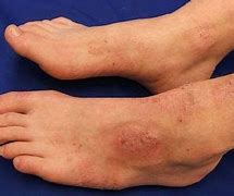 Image result for Rash On Foot and Ankle