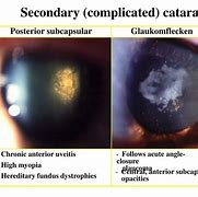 Image result for Complicated Secondary Cataract