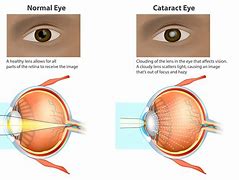 Image result for What Is a Second Cataract