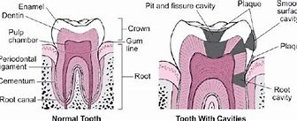 Image result for Teeth with Cavities