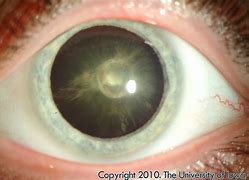 Image result for Juvenile Cataract