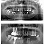 Image result for Dental Implant