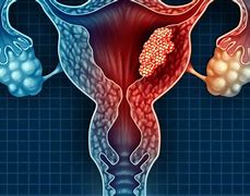 Image result for Cervical Cancer Surgery