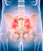 Image result for Lower Back Pain Sacroiliac Joint