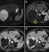 Image result for Hemangioma Liver MRI