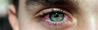 Image result for Pink Eye or Allergies