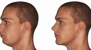 Image result for People with No Lower Jaw