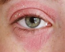 Image result for Allergic Rash around Eyes