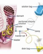 Image result for How Effective Is Dialysis