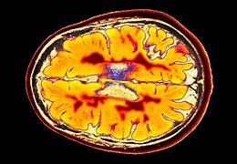 Image result for Parkinson's Brain MRI