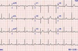 Image result for 12 Lead EKG Clip Art