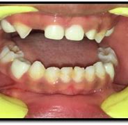 Image result for Zirconia Crown Tooth