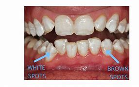 Image result for Molar Tooth Spike