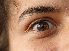 Image result for Alopecia Eyebrows