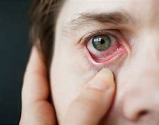 Image result for Itchy Eyes Type