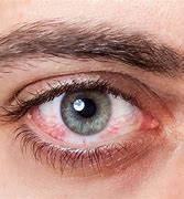 Image result for Itchy Eyes Allergies