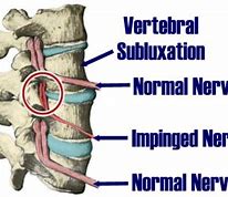 Image result for Lumbosacral Subluxation