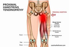 Image result for Tendinopathy Hamstring Knee